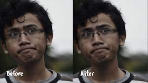 Dengan demikian, cara menghilangkan jerawat sangat diperlukan agar bisa memudahkan menghilangkan jerawat. Menghilangkan Jerawat Wajah Di Video Kamu Bisa Takatik