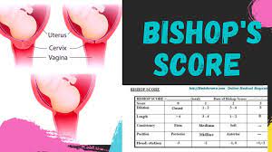 The score is determined from the fetal station and four characteristics of the. Bishop S Score Pre Induction Score Youtube