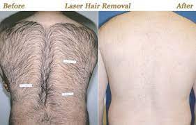 50 to 90% off deals in minnesota. Men Botox Laser Hair Removal Skin Care Minneapolis Mn