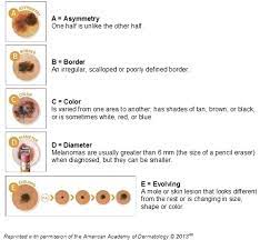 If you aren't sure which type of skin cancer. Early Detection Of Melanoma Reviewing The Abcdes Sciencedirect