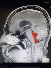 Comment s'attrape un ténia et s'en débarrasser ? Patient Bizarre Il Vivait Avec Un Ver Solitaire Dans Le Cerveau Depuis 14 Ans