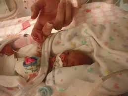 Premature Baby Micro Preemie 23 Weeks Gestation Premature Baby Micro Preemie Preemie Babies