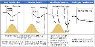 Image result for Early Deceleration