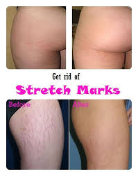 5 Best Stretch Marks Remedies Natural Easy And Fast Diy Treatment Skin Care Salud Y Belleza Manchas En La Piel Cuidado De La Piel