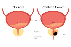 Image result for Prostate Cancer