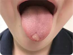 Image result for mouth ulcer on tongue)