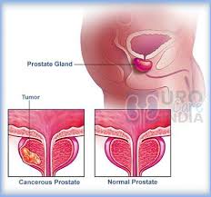 Pin Auf Prostate Problems In Men