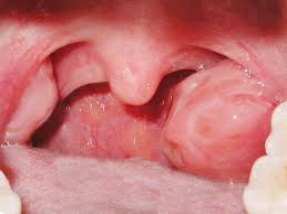 Things like your age, health. One Tonsil Larger Than The Other A Sign Of Cancer Fauquier Ent Blog