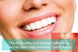 Maybe you would like to learn more about one of these? The Most Effective Method To Reverse Cavities Naturally And Heal Tooth Decay Cokbilenler Com