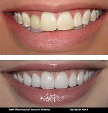 All the time is necesary to put a barrier in the gums to protect it. Teeth Whitening A Guide About Treatment Options And What To Expect