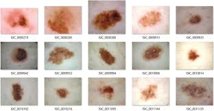 If you have skin cancer, it is important to know which type you have because it affects your treatment options and your outlook (prognosis). Melanoma Skin Cancer Detection Method Based On Adaptive Principal Curvature Colour Normalisation And Feature Extraction With The Abcd Rule Springerlink