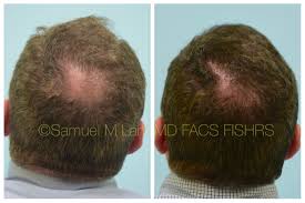 We are the best hair transplant clinic in delhi ncr having years of experience in this field. This 57 Year Old Gentleman Is Shown Before And 6 Months After Hair Transplant To The Hairline Midscalp Hair Transplant Procedure Dallas Hair Hair Restoration