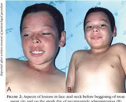 Figure 2 from Endogenous pellagra and cerebellar ataxia without  aminoaciduria . Hartnup disease ?