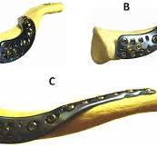 Contoured lateral clavicle locking plate. The plates have ...