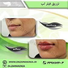 تزریق فیلر - هزینه تزریق فیلر صورت - بهترین دکتر تزریق فیلر - دکتر زمانی نیا