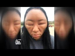 Hair Dye Nightmare Dyed Hair Hair Dye Allergy Celebrity Health
