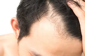Free shipping on orders over $25 shipped by amazon. Male Pattern Baldness Vegas Valley Hair Restoration