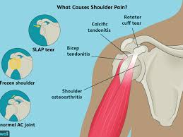 Some people experience only neck pain or only shoulder pain, while others experience pain in both areas. Anatomy Of The Human Shoulder Joint