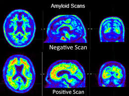 Ct and mri scans have been directly linked to greater life expectancy and declining cancer death when the field is turned off, the protons return to their normal spin in a process called precession. Amyloid Pet Scan For Alzheimer S Disease Assessment Ucsf Radiology