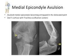 The redundancy of terms has made interpretation of the literature challenging. Paediatric Elbow Fractures