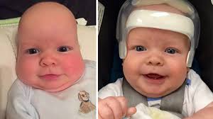 Infant Matthew Boler doing well after undergoing to fix craniosynostosis,  which caused unusual skull shape