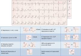 Ischaemic Heart Disease Ecg Cardiovascular Disease