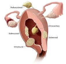 Also called leiomyomas, uterine fibroids aren't associated with an increased risk of uterine cancer but can cause debilitating symptoms in many women. Advanced Fibroid Treatment Individualized Fibroid Treatment Collaborative