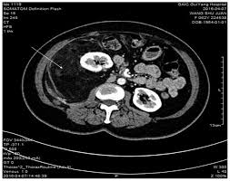 Image result for Liposarcoma