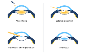 Image result for Cataract Extraction