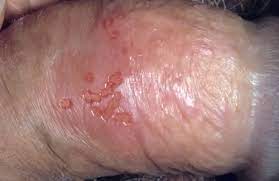 Forumul boli cu transmitere sexuala: Infectiile Bacteriene Cu Transmitere Sexuala