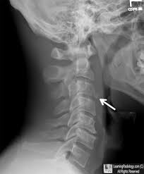Learningradiology Extension Teardrop Fracture Cervical Spine Radiography Pinterest