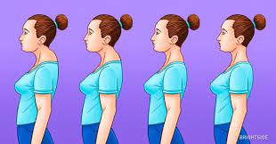 The medical name of this condition is dorsocervical fat pad. My Name Is Humpty Dowager S Hump Jillian Ryan Photography