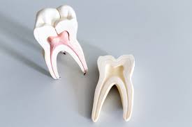 Durch eine wurzelbehandlung kann ein entzündeter zahn erhalten werden. Wurzelbehandlung Zahnerhalt Trotz Entzundetem Nerv Dr Zastrow Kollegen