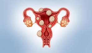 Medical illustration of the uterus with uterine fibroids in various locations