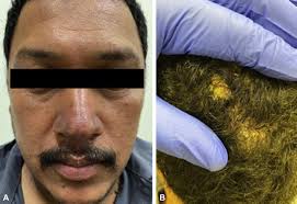 Pemphigus foliaceus presenting with violaceous, painful nodules and an  aberrant auto-antibody expression in a Latino patient