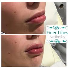 Results & reviews — Finer Lines Aesthetics