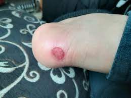 When New Shoes Scrape The Back Of Your Heels Mildlyinfuriating