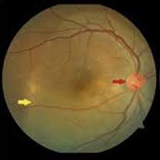 Image result for Neurosyphilis