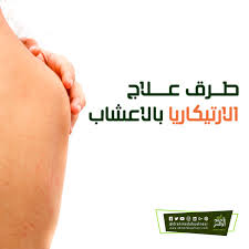 علاج الارتيكاريا المزمنة بالاعشاب