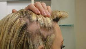 Can hair extensions lead to hair loss? Clip In Hair Extensions Can Cause Traction Alopecia If Worn For Over 5 Hours A Day By Diane Shawe All About On Demand Courses Hair Extensions And Franchise Opportunity By Diane Shawe