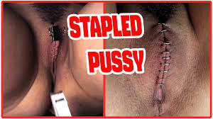 Sadistic Doctor Closes and Staples His Patients Pussy: Spanish Hairy Porn