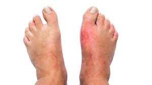 Memijat pada teknik ini adalah dengan tekanan pada ibu jari tangan dan telunjuk. Jempol Kaki Bengkak Ini 8 Penyebab Dan Cara Mengatasinya