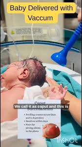 Image result for Vacuum Caput