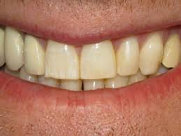 Health Tips If you are troubled by yellowing of teeth try these effective  home remedies | Health Tips: दांतों के पीलेपन से हैं परेशान, तो आजमाएं ये  असरदार घरेलू उपाय