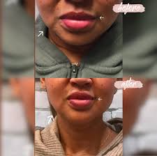 Look at this beautiful Botox result ❤️❤️ On this beautiful patient we  worked