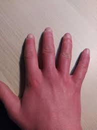 Rote Heisse Hande Rotungen An Den Handoberflachen Gesundheit Und Medizin Haut Hand