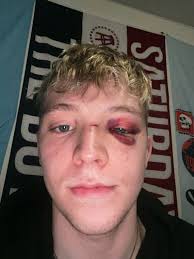 Attorney representing student allegedly punched by UI football player calls  for action