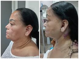Neck lift Prices & Packages 2025
