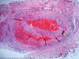 Image result for Jaw Claudication