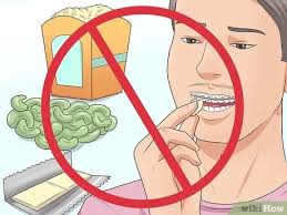 The neck brace helps your neck support the weight of your head while the soft tissues in your neck have a chance to heal. How To Make Your Braces Hurt Less With Pictures Wikihow